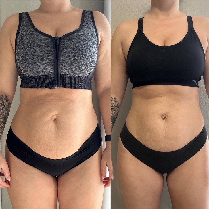 6 Week Diastasis Recti Progress